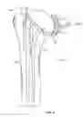 Fig. 09 - Patient-specific cutting guide for the shoulder