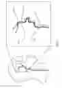 Fig. 03 - Post-conditioning suction catheter apparatus and methods