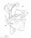 Fig. 19 - Methods and devices for puncturing tissue