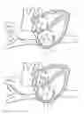 Fig. 23 - Methods and devices for puncturing tissue