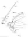 Fig. 32 - Apparatus and methods for bone repair preparation
