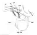 Fig. 28 - Tether clamp and implantation system