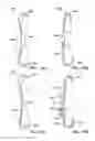 Fig. 08 - METHODS AND SYSTEMS FOR LATERALLY STABILIZED CONSTRAINT OF SPINOUS PROCESSES