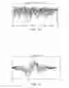 Fig. 07 - Ventricular far field reduction