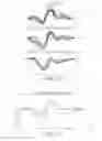 Fig. 08 - Ventricular far field reduction