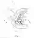 Fig. 04 - Electrosurgical instrument with integral tissue removal feature