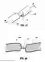 Fig. 22 - Vessel sealer and divider for use with small trocars and cannulas