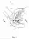Fig. 04 - Electrosurgical instrument with removable jaw components