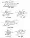 Fig. 32 - ENHANCED FLUOROGENIC ENDOLUMINAL FILTER STRUCTURE