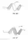 Fig. 33 - ENHANCED FLUOROGENIC ENDOLUMINAL FILTER STRUCTURE