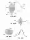 Fig. 50 - ENHANCED FLUOROGENIC ENDOLUMINAL FILTER STRUCTURE