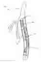Fig. 01 - Differential dilation stent and method of use