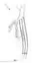 Fig. 02 - Differential dilation stent and method of use