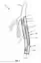 Fig. 04 - Differential dilation stent and method of use