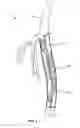 Fig. 05 - Differential dilation stent and method of use