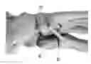 Fig. 01 - CORRECTION OF FIRST RAY DEFORMITY VIA PERONEUS LONGUS TENDON MODIFICATION