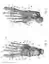Fig. 04 - CORRECTION OF FIRST RAY DEFORMITY VIA PERONEUS LONGUS TENDON MODIFICATION