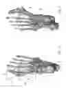 Fig. 08 - CORRECTION OF FIRST RAY DEFORMITY VIA PERONEUS LONGUS TENDON MODIFICATION