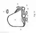 Fig. 09 - CORRECTION OF FIRST RAY DEFORMITY VIA PERONEUS LONGUS TENDON MODIFICATION