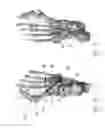 Fig. 10 - CORRECTION OF FIRST RAY DEFORMITY VIA PERONEUS LONGUS TENDON MODIFICATION
