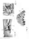 Fig. 11 - CORRECTION OF FIRST RAY DEFORMITY VIA PERONEUS LONGUS TENDON MODIFICATION