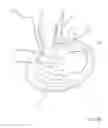 Fig. 06 - OSSICULAR PROSTHESIS HAVING SPIKES