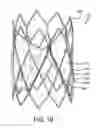 Fig. 28 - Prosthetic valved conduits with mechanically coupled leaflets