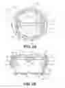 Fig. 05 - Vertebral implants and methods for installation thereof