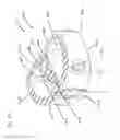 Fig. 52 - Device for securing an implant to tissue