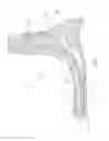 Fig. 02 - PROSTHETIC SPACER DEVICES, SYSTEMS, AND METHODS