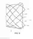 Fig. 06 - Integrated stent repositioning and retrieval loop