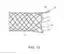 Fig. 07 - Integrated stent repositioning and retrieval loop
