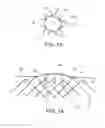 Fig. 10 - Integrated stent repositioning and retrieval loop