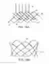 Fig. 13 - Integrated stent repositioning and retrieval loop