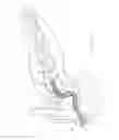 Fig. 03 - Endoluminal device