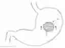 Fig. 01 - Temporary gastric device (TGD) and method of use