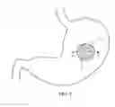Fig. 02 - Temporary gastric device (TGD) and method of use