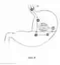 Fig. 07 - Temporary gastric device (TGD) and method of use
