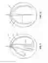 Fig. 08 - Temporary gastric device (TGD) and method of use