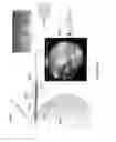 Fig. 12 - Ocular implant delivery systems and methods