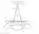Fig. 01 - KERATOCONUS TREATMENT