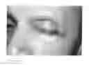Fig. 02 - Tarsus eyelid patch