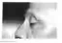 Fig. 09 - Tarsus eyelid patch