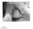 Fig. 11 - Tarsus eyelid patch