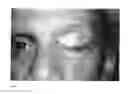Fig. 14 - Tarsus eyelid patch