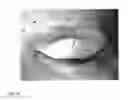 Fig. 16 - Tarsus eyelid patch