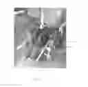 Fig. 10 - Removable leg rest for wheelchairs