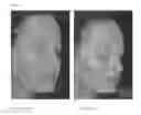Fig. 09 - TREATMENT OF PAPULOPUSTULAR ROSACEA WITH IVERMECTIN