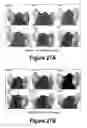 Fig. 15 - Molecular and Herbal Combinations for Treating Psoriasis