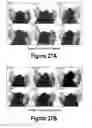 Fig. 15 - Molecular and Herbal Combinations for Treating Psoriasis